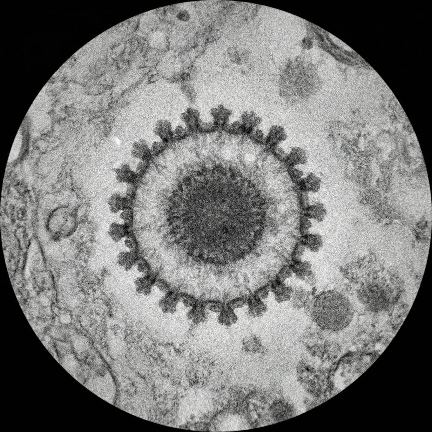 사스코로나바이러스-2 5